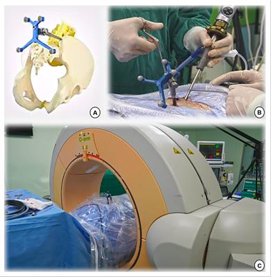 Unilateral biportal endoscopic lumbar interbody fusion assisted by intraoperative O-arm total navigation for lumbar degenerative disease: A retrospective study